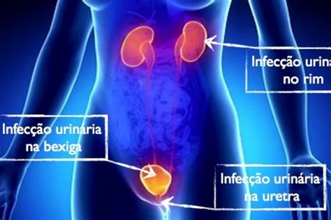 o que causa infecção urinária - que es un cuadro sinoptico